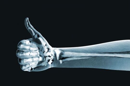 Οι ακτινογραφίες μπορούν να βοηθήσουν στη διάγνωση του πόνου στις αρθρώσεις των δακτύλων