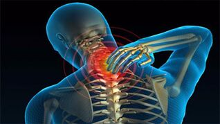 Αιτίες της οστεοχόνδρωσης του λαιμού